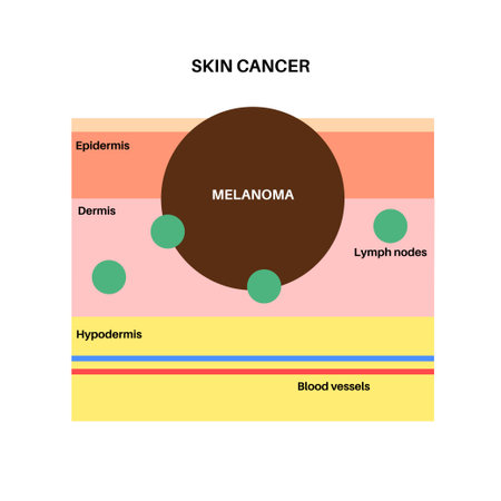 Melanoma graphic posterのイラスト素材