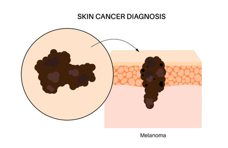 Skin cancer diagnosisのイラスト素材