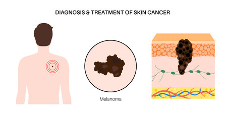 Skin cancer diagnosisのイラスト素材