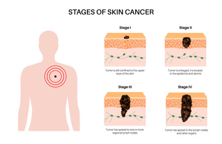 Melanoma stages posterのイラスト素材
