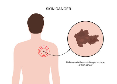 Skin cancer diagnosisのイラスト素材