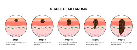 Melanoma stages posterのイラスト素材