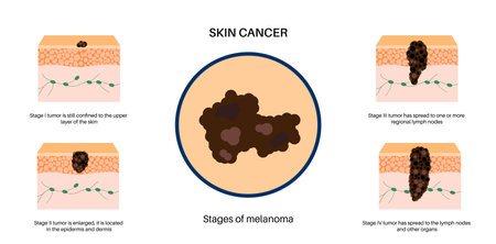 Melanoma stages posterのイラスト素材