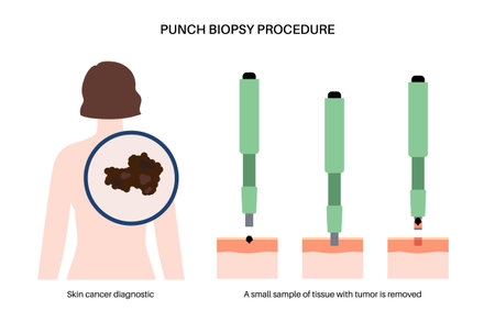 Punch biopsy procedureのイラスト素材