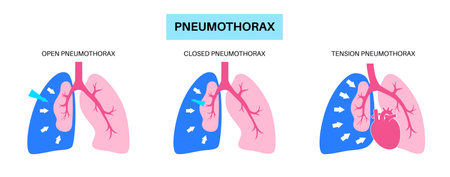 Pneumothorax anatomical posterのイラスト素材