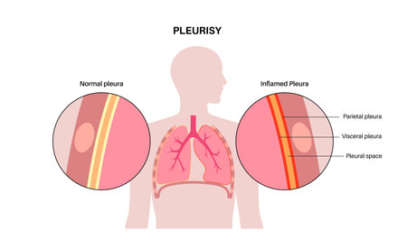 Pleurisy inflammation diseasesのイラスト素材