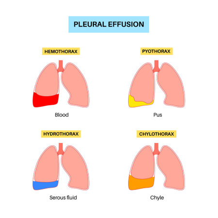Pleural effusion posterのイラスト素材