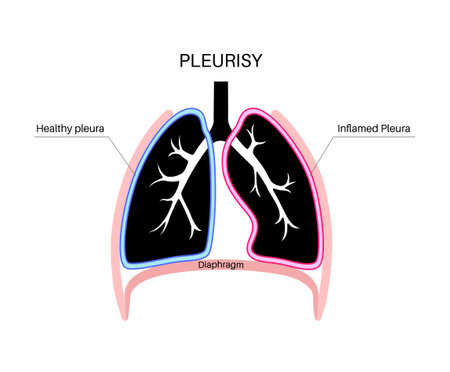 Pleurisy inflammation diseasesのイラスト素材