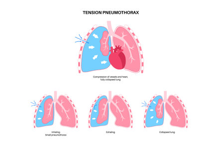 Tension pneumothorax posterのイラスト素材