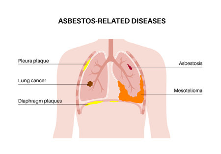 Asbestos related diseasesのイラスト素材