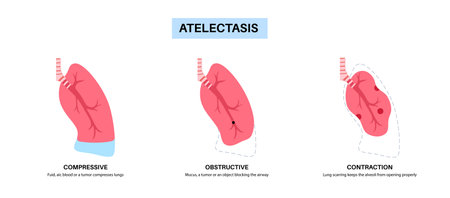 Atelectasis medical posterのイラスト素材