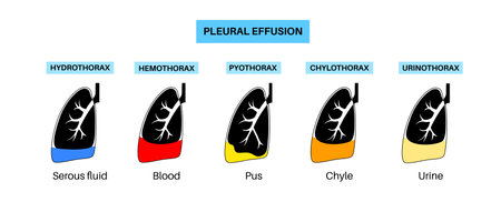 Pleural effusion posterのイラスト素材
