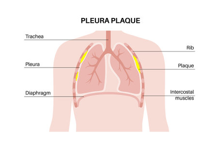 Pleural plaque posterのイラスト素材