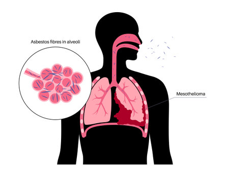 Mesothelioma cancer diseaseのイラスト素材