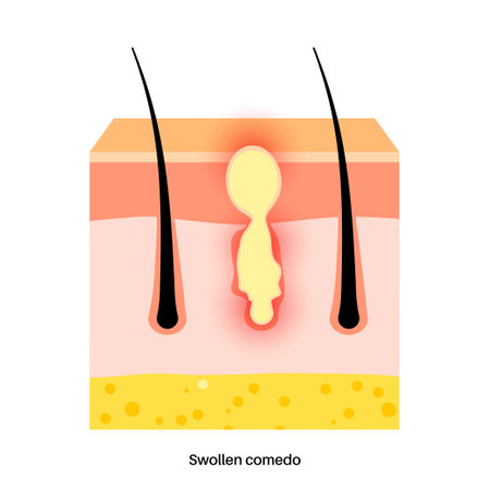Acne treatment posterのイラスト素材