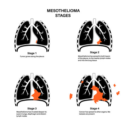 Mesothelioma cancer stagesのイラスト素材