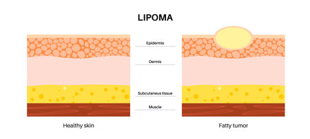 Lipoma medical posterのイラスト素材