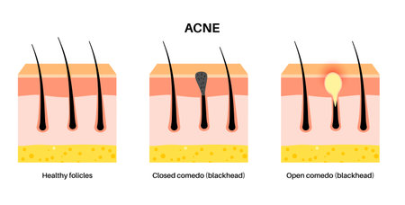 Acne treatment posterのイラスト素材