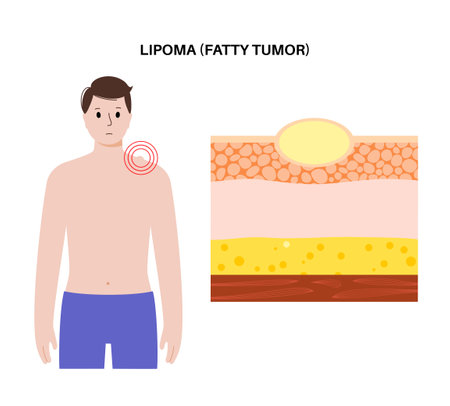 Lipoma medical posterのイラスト素材