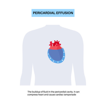 Pericardial effusion heartのイラスト素材