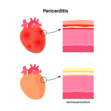 Pericarditis heart diseaseのイラスト素材