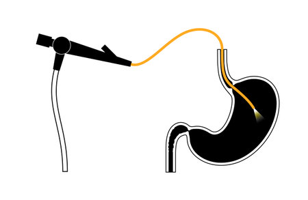 Gastroscopy endoscopy procedureのイラスト素材