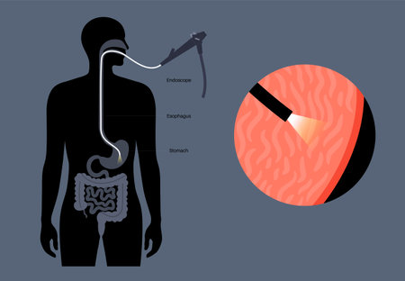 Gastroscopy endoscopy procedureのイラスト素材
