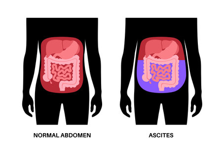 Ascites disease posterのイラスト素材