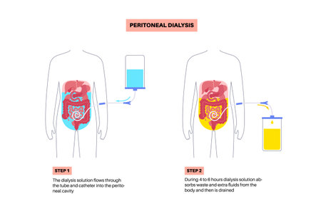 Peritoneal dialysis conceptのイラスト素材