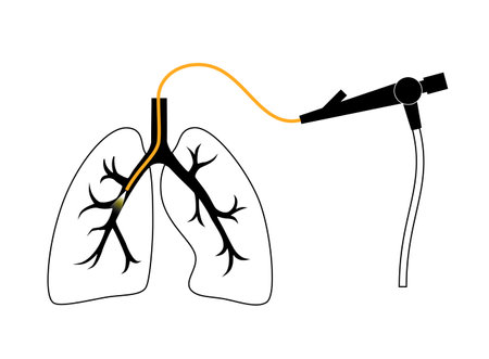 Bronchoscopy procedure conceptのイラスト素材