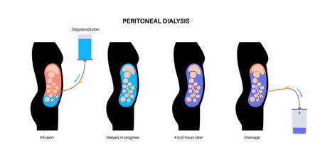 Peritoneal dialysis conceptのイラスト素材