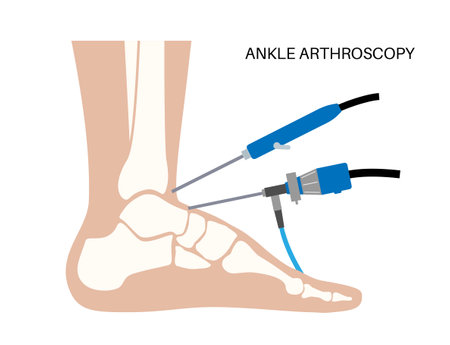 Ankle arthroscopy posterのイラスト素材