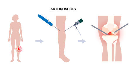 Knee joint arthroscopyのイラスト素材