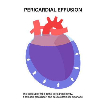 Pericardial effusion heartのイラスト素材