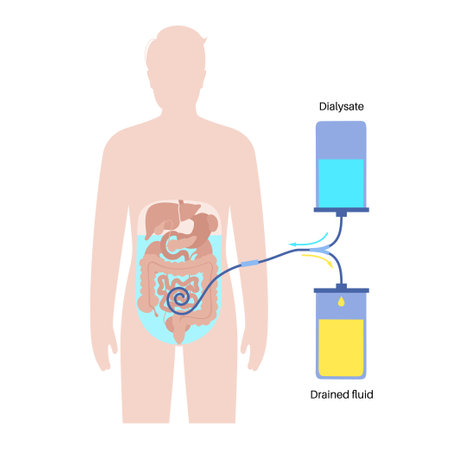 Peritoneal dialysis conceptのイラスト素材