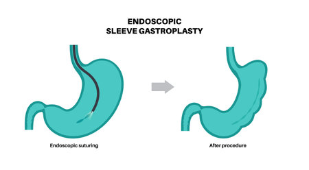 Endoscopic sleeve gastroplastyのイラスト素材