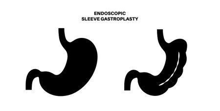 Endoscopic sleeve gastroplastyのイラスト素材