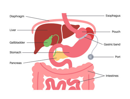 Gastric band posterのイラスト素材