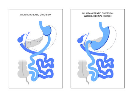 Biliopancreatic diversion procedureのイラスト素材