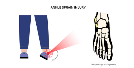 Sprained ankle injuryのイラスト素材