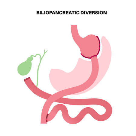 Biliopancreatic diversion procedureのイラスト素材