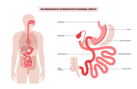 Biliopancreatic diversion procedureのイラスト素材