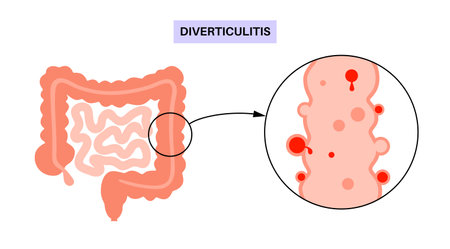 Diverticulitis and diverticulosisのイラスト素材