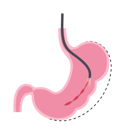Endoscopic sleeve gastroplastyのイラスト素材