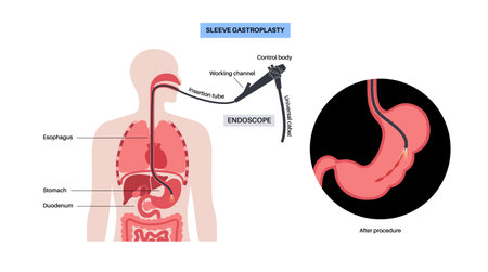Endoscopic sleeve gastroplastyのイラスト素材
