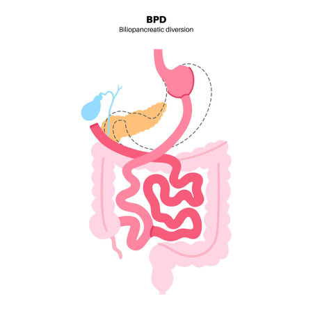 Biliopancreatic diversion procedureのイラスト素材