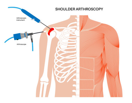 Shoulder arthroscopy posterのイラスト素材