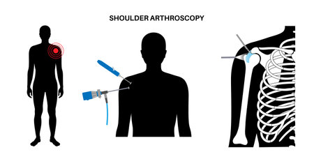 Shoulder arthroscopy posterのイラスト素材