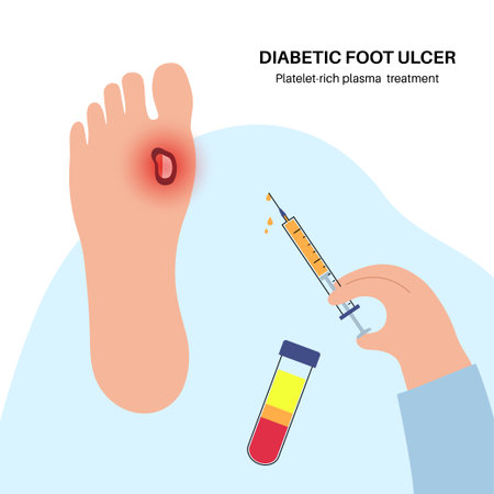 Diabetic Foot Ulcersのイラスト素材