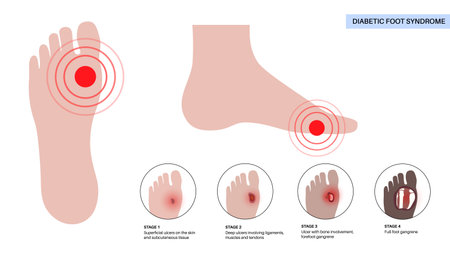 Diabetic Foot Ulcersのイラスト素材